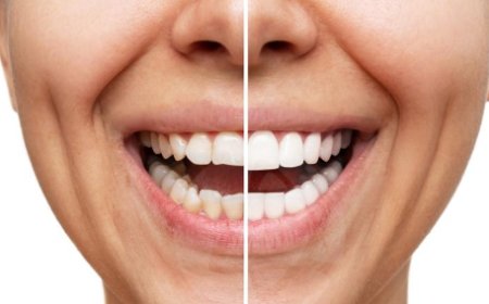 Saiba os prós e contras das lentes  de contato dentais usadas por famosos