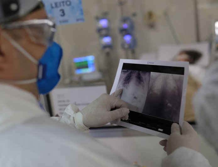 Broncopneumonia: doença que levou Bolsonaro à UTI