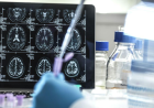 Medicamento para Alzheimer chega ao Brasil em junho