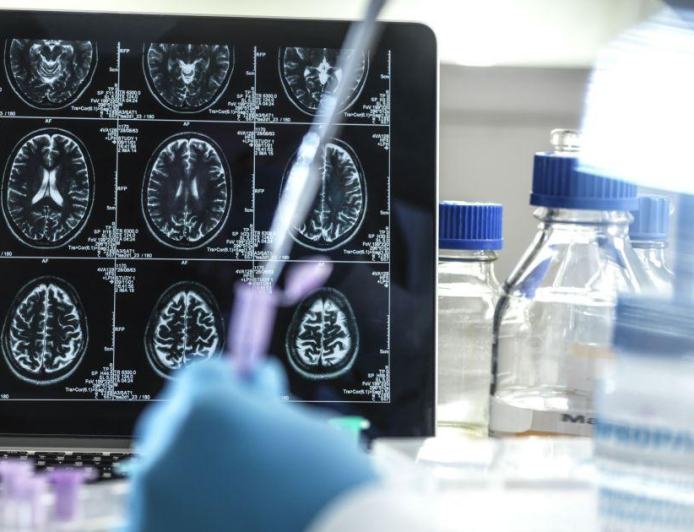 Medicamento para Alzheimer chega ao Brasil em junho