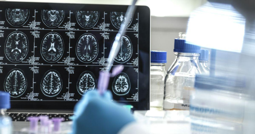 Medicamento para Alzheimer chega ao Brasil em junho