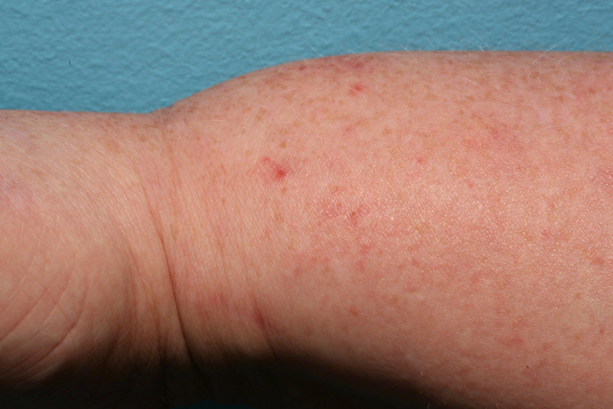 Alterações na pele e coceira podem ocorrer em casos de dengue, zika e chikungunya, mas não são suficientes para identificar a doença.